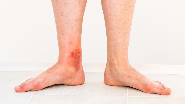 疤痕性脱发怎么办 改善疤痕性脱发的3个方法介绍