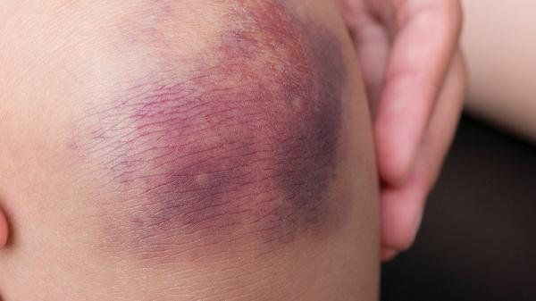 伤口愈合过程分哪几个时期