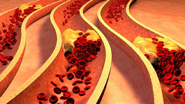 血友病如何预防发作 血友病的3个预防方法盘点
