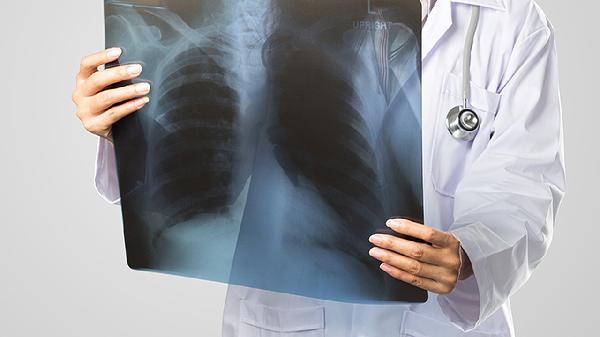 肺大疱破了会不会死