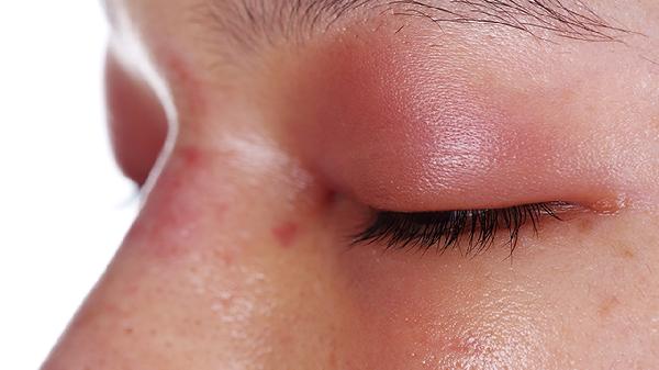 红斑狼疮急性发作会怎么样