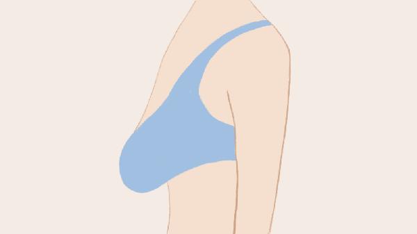 妙桃假体丰胸会有后遗症吗